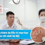 Hướng dẫn cách trị mụn trứng cá tuổi dậy thì